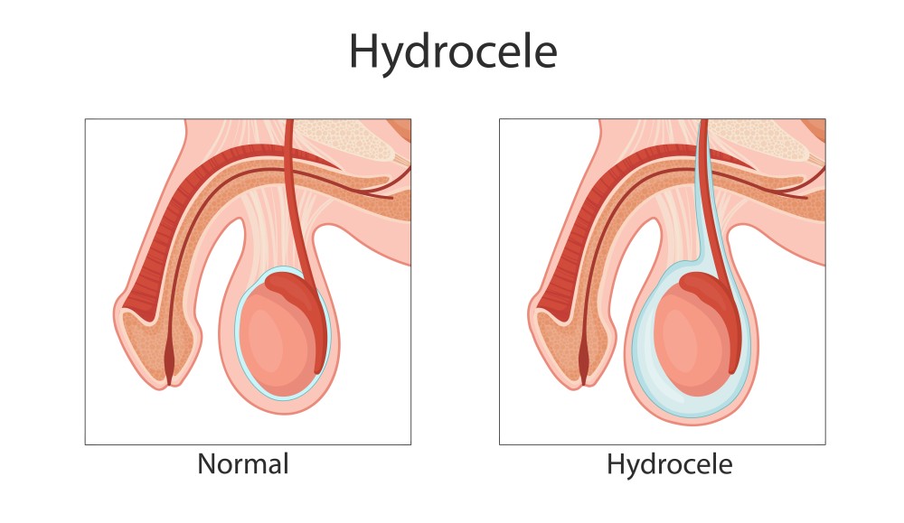 Hydrocele