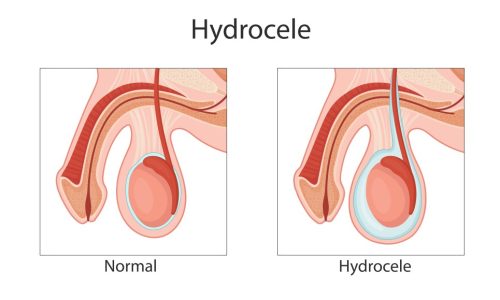 Hydrocele