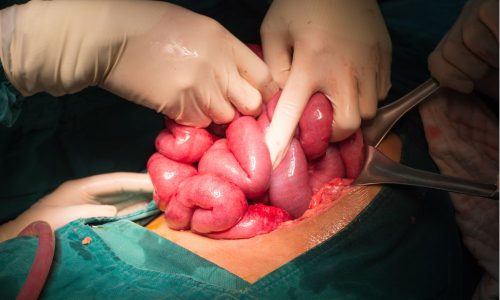 Bowel Surgeries